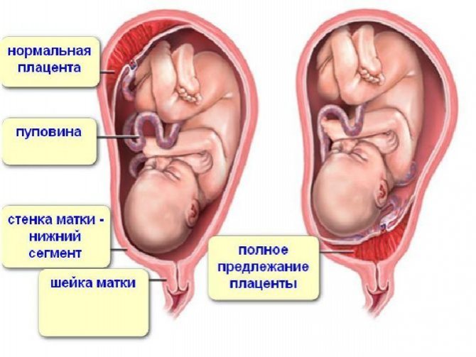 Про передлежанні плаценти при вагітності: що це таке, чим небезпечне, як лікувати? Про передлежанні плаценти при вагітності: що це таке, чим небезпечне, як лікувати?