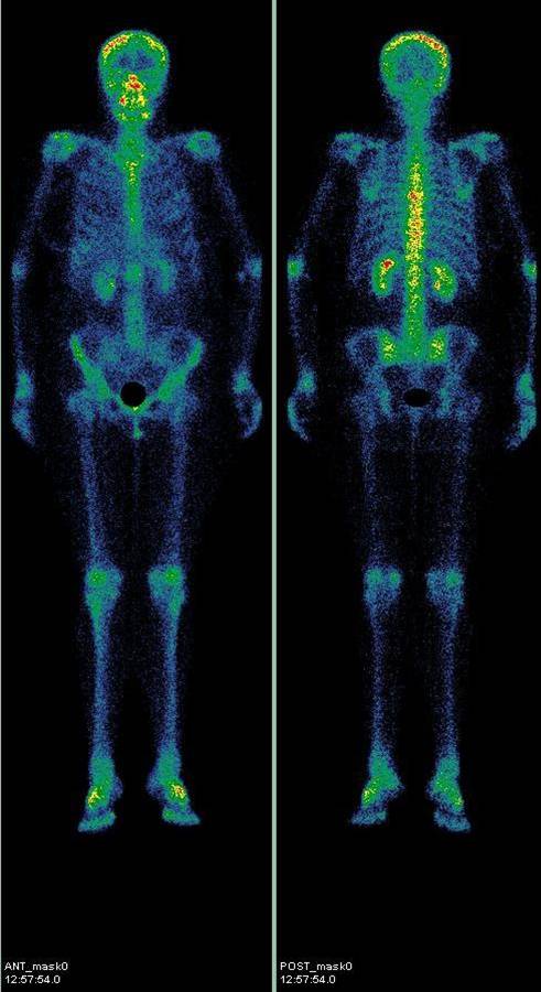 Нормальна сцінтіграмм кісток скелета в передній і задній проекції