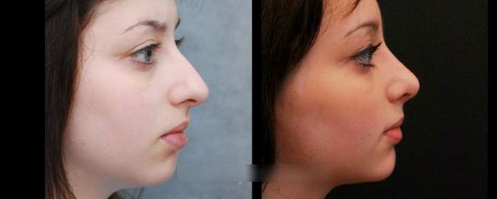 Ринопластика носа – види, показання, протипоказання і фото