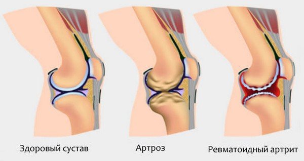 знерухомлення хворого суглоба