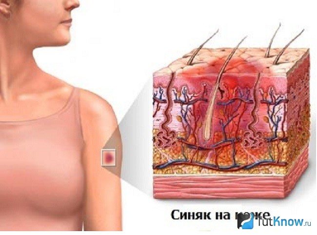 Освіта синяка на шкірі