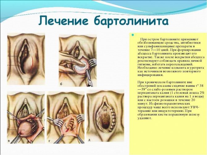 Операція для лікування бартолинита