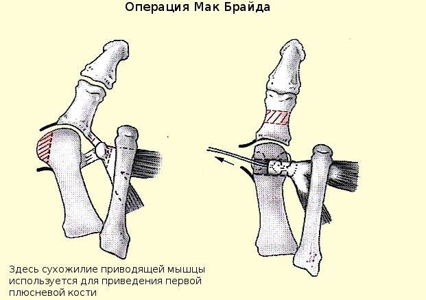 Операція по Мак Брайд