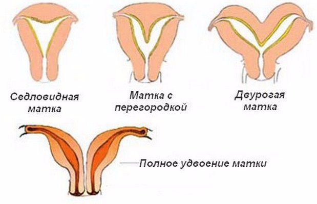 Опис різновидів дворогій матки