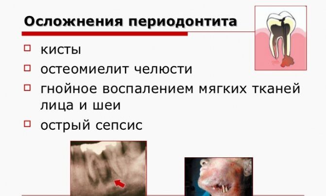 Опис гострого періодонтиту: причини, симптоми, діагностика та лікування