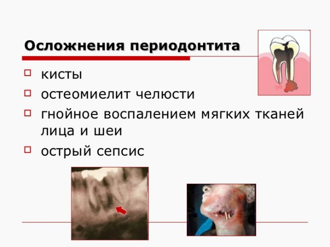 Опис гострого періодонтиту: причини, симптоми, діагностика та лікування