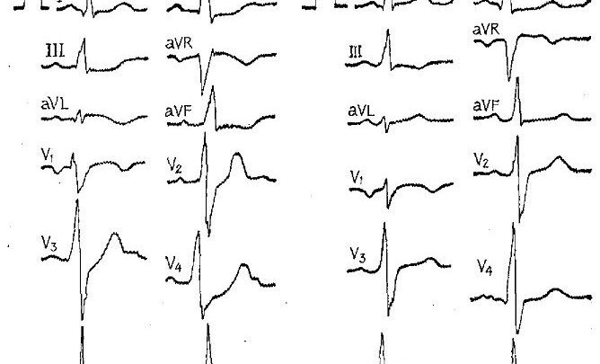 Причини інфаркту міокарда: причини виникнення та фактори, що привертають