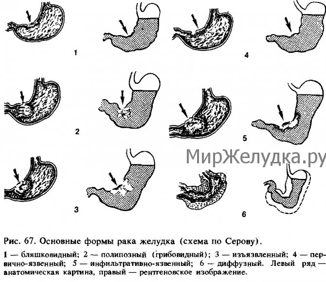 Основні форми раку шлунка