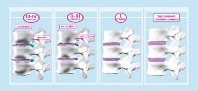 Основні стадії остеохондрозу і їх опис