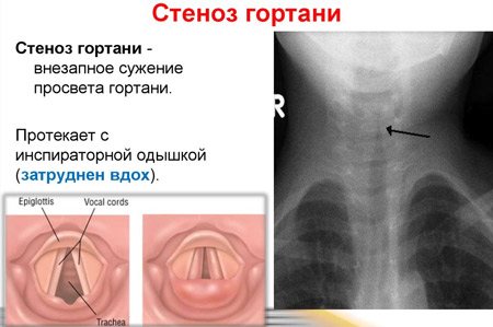 особливості стенозу