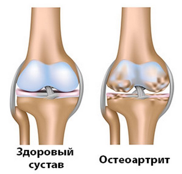 остеоартрит суглобів