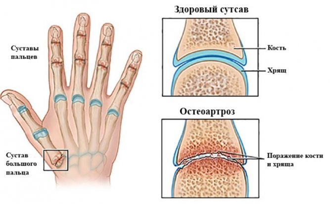 остеоартроз ручок