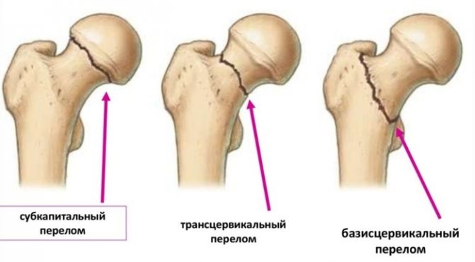 Остеопороз.  Що це таке, причини, симптоми, як лікувати