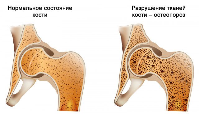 остеопороз