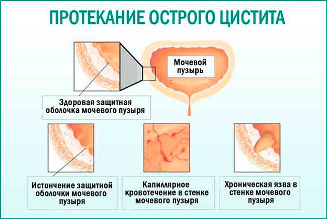 гострий цистит