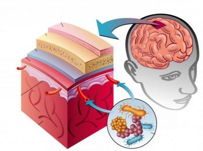 Гострий менінгіт: симптоми, що це таке, особливості серозного виду