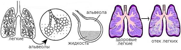 Набряк легенів