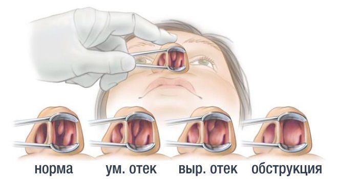 набряк в порожнині носа