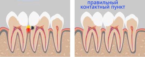 відсутність правильного контактного пункту між зубами