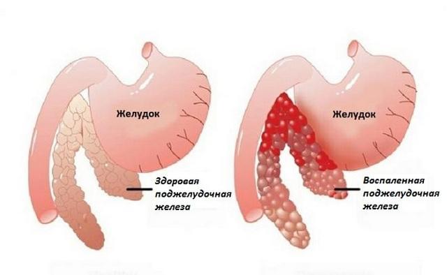 панкреатит