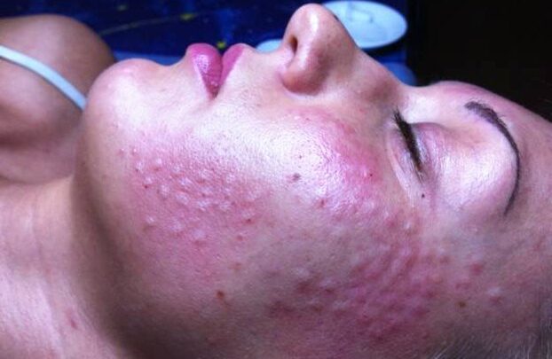 Папули після биоревитализации: скільки тримаються, як швидко позбутися