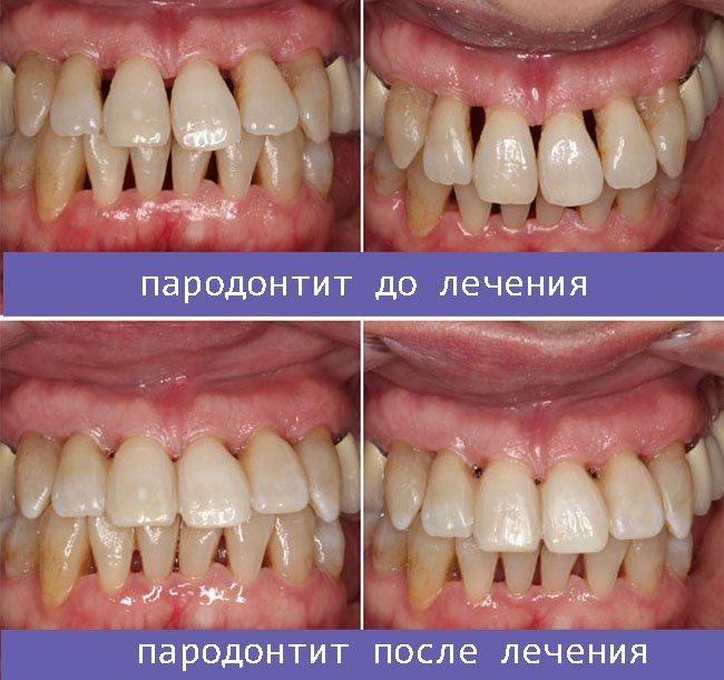 пародонтит до і після лікування