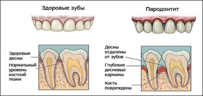 Пародонтит у детей фото