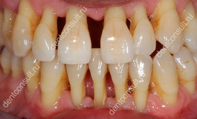 Пародонтоз – лікування в домашніх умовах народними засобами