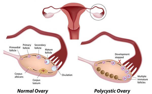 Мультіфоллікулярние яєчники: Що це, причини і лікування.
