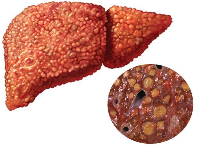 печінкова недостатність