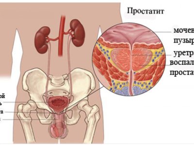 Перші ознаки і симптоми простатиту у чоловіків: опис, лікування та фото