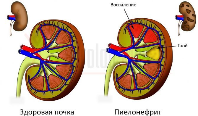 Таблетки від запалення сечового міхура для чоловіків і чи можна вилікуватися в домашніх умовах