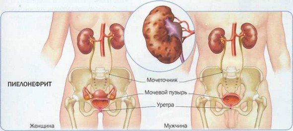 пієлонефрит