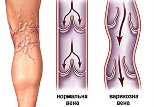 Пластика грудних залоз.  Показання, як проводиться операція з імплантами і без, результати, фото, наслідки