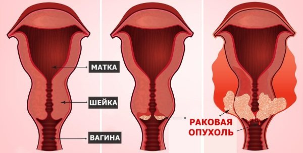 Як проявляється рак шийки матки (РШМ) – боротьба з карциномою