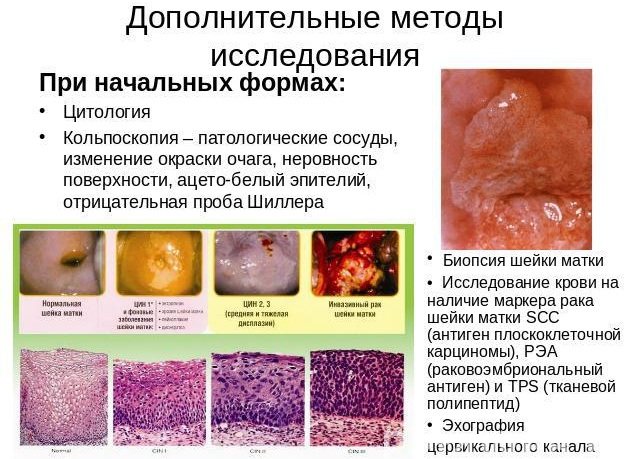 Плоскоклітинна карцинома шийки матки з тенденцією до зроговіння.  Що це таке, симптоми, прогноз, лікування