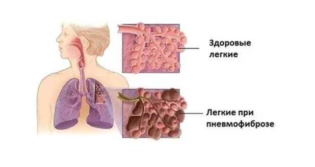 пневмофіброз