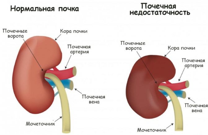 Ниркова недостатність.  Симптоми у жінок, гостра, хронічна, термінальна, преренальная.  Стадії, ознаки, причини і лікування