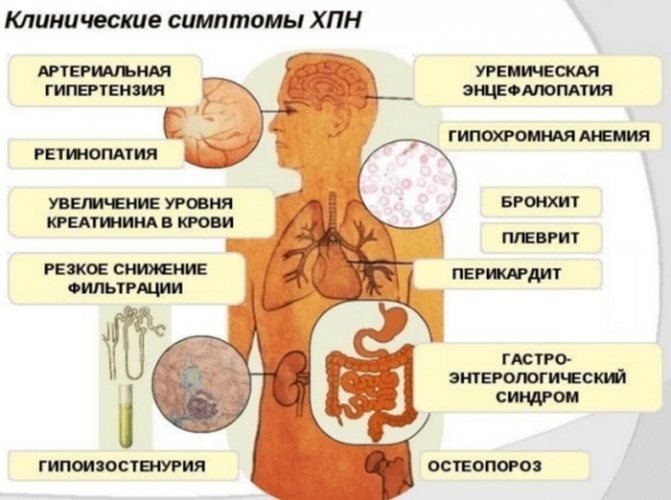 Ниркова недостатність.  Симптоми у жінок, гостра, хронічна, термінальна, преренальная.  Стадії, ознаки, причини і лікування