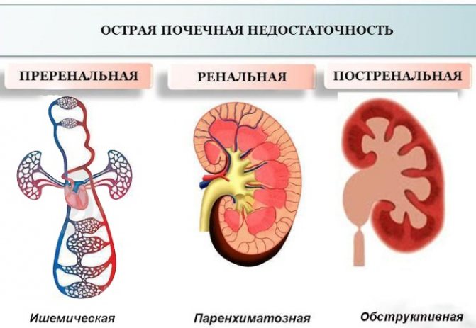 Ниркова недостатність.  Симптоми у жінок, гостра, хронічна, термінальна, преренальная.  Стадії, ознаки, причини і лікування