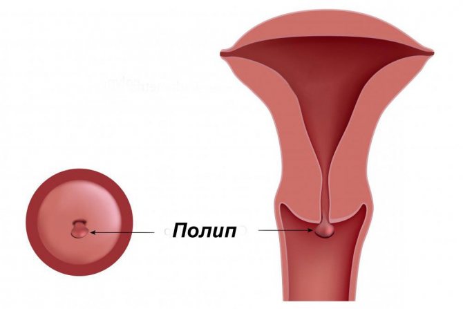 Поліп шийки матки