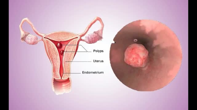 поліпоз матки