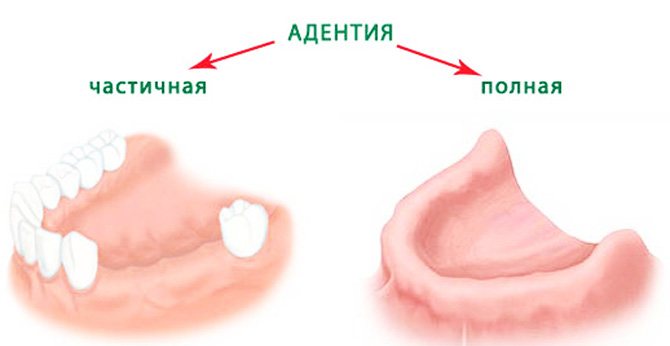 Повна і часткова адентія