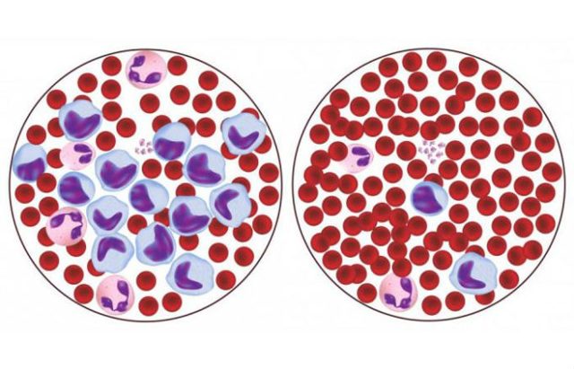 Знижені лімфоцити в крові: причини зниження в аналізі, що це значить у дорослих