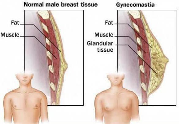 після видалення гінекомастії