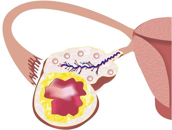 Подивимося, що таке лютеиновая кіста, як вона проявляє себе і чи потрібно лікування ...