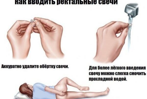 Які свічки ефективніше допоможуть впоратися з запором