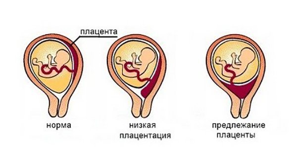 Передлежання плаценти при вагітності