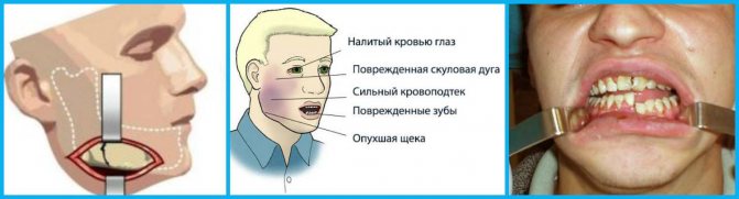 При яких захворюваннях відбувається оніміння щелепи і що з цим робити