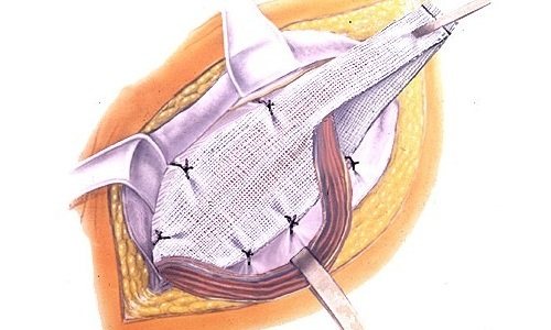 При ненатяжной герніопластики грижові ворота закривають сітчастим имплантом, що утримує органи в черевній порожнині